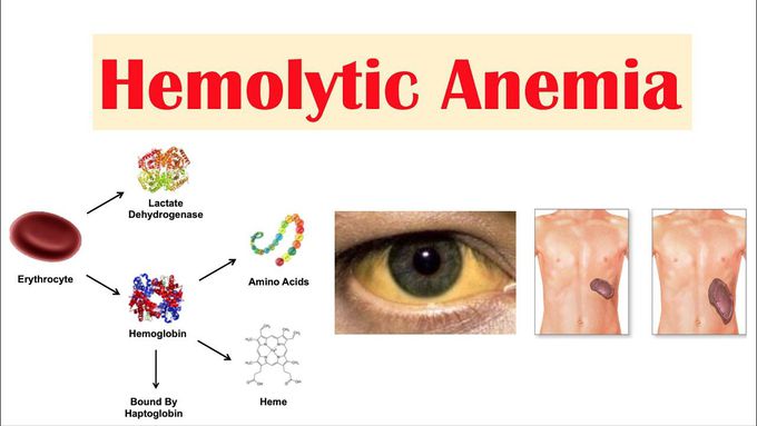 Hemolytic anemia - MEDizzy