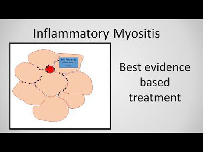 Myositis (Inflammation myopathy)