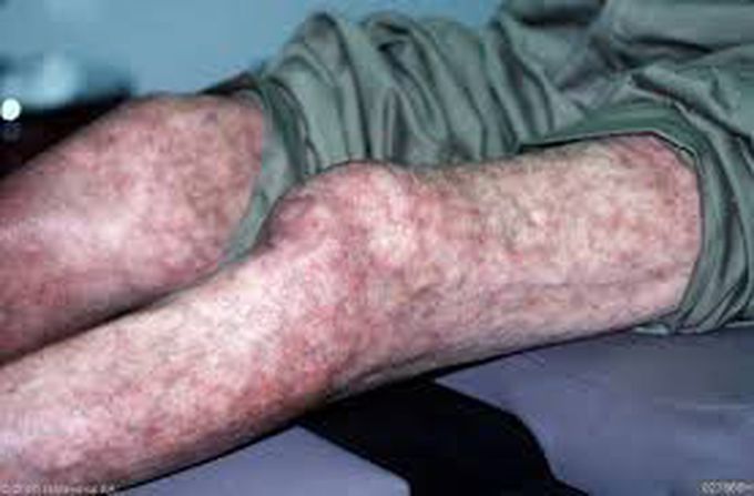 Dx? And it's the side effect of which drug? - MEDizzy