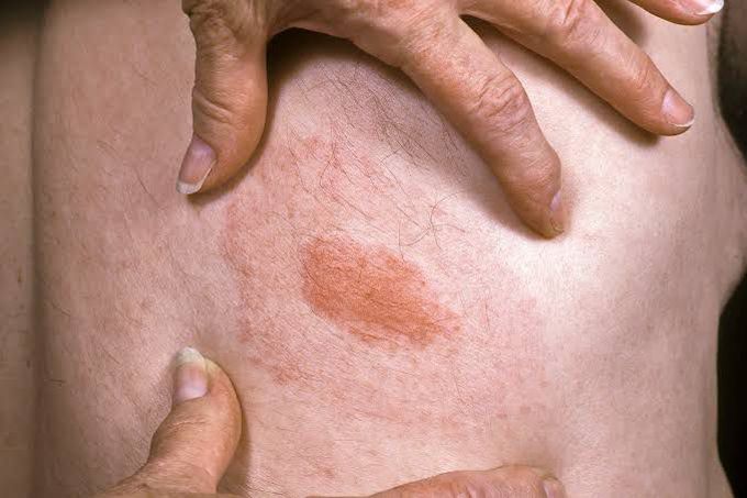 Erythema Migrans
