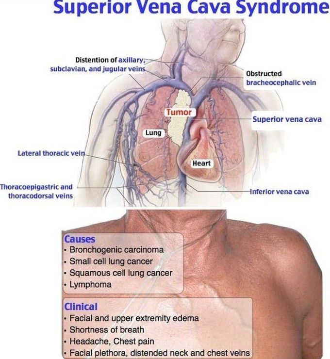 Superior vena cava