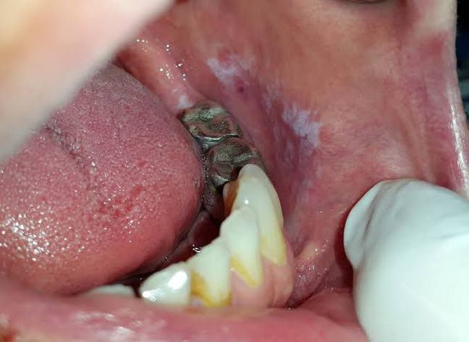 Lichenoid Reaction