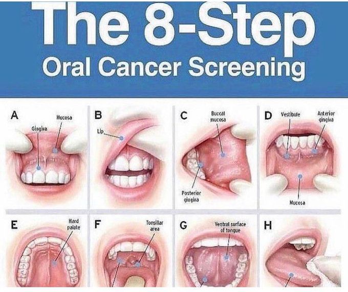 Oral cancer screening