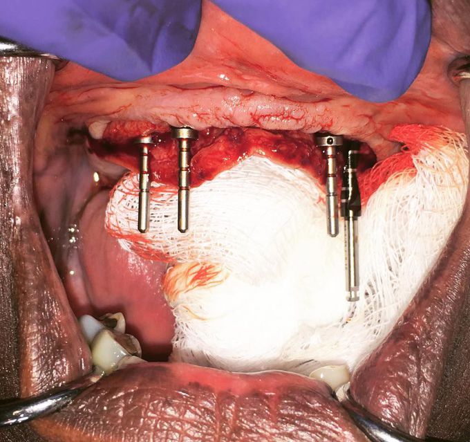 Four implants being prepared on the maxilla for a spankin' new denture 👄🍔🍕🍴 