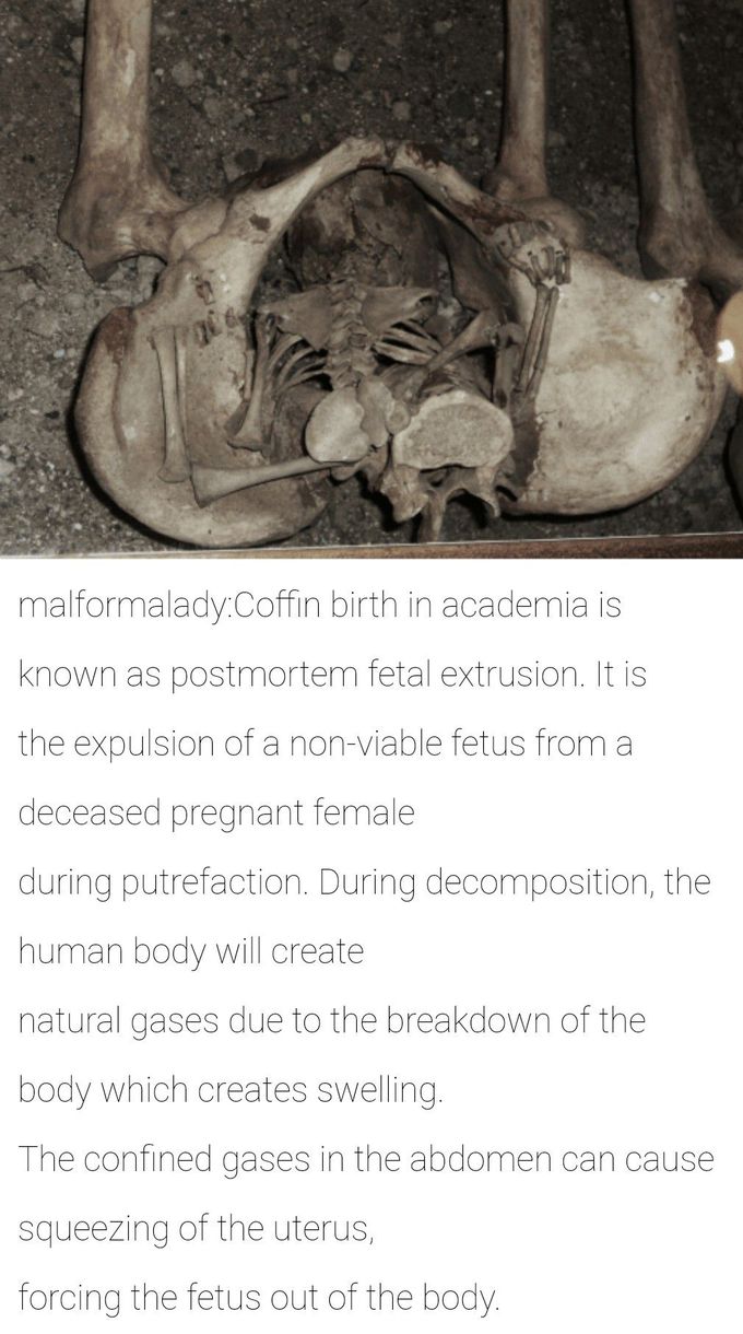 Coffin birth