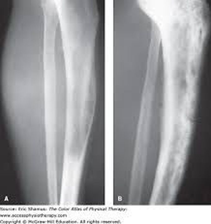 Treatment for pagets disease