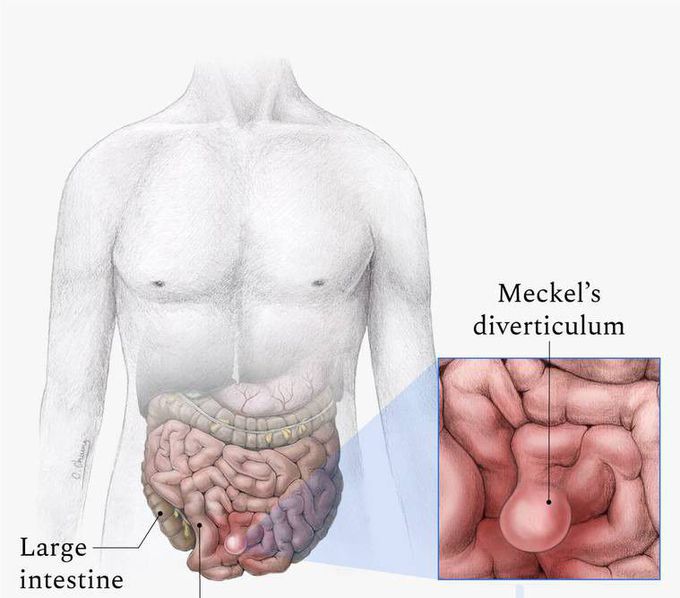 Meckel's diverticulum