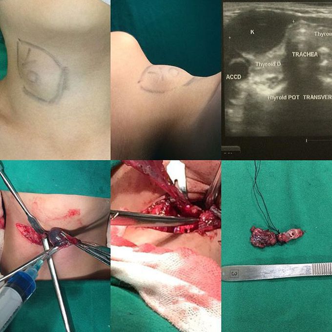 Thyroglossus duct cyst 