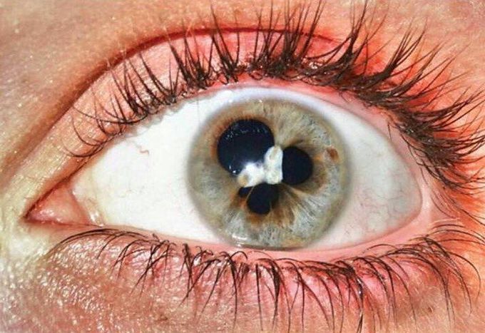 Persistent pupillary membrane
