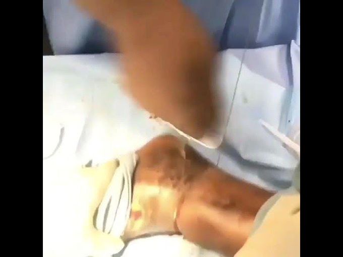 AMPUTATION