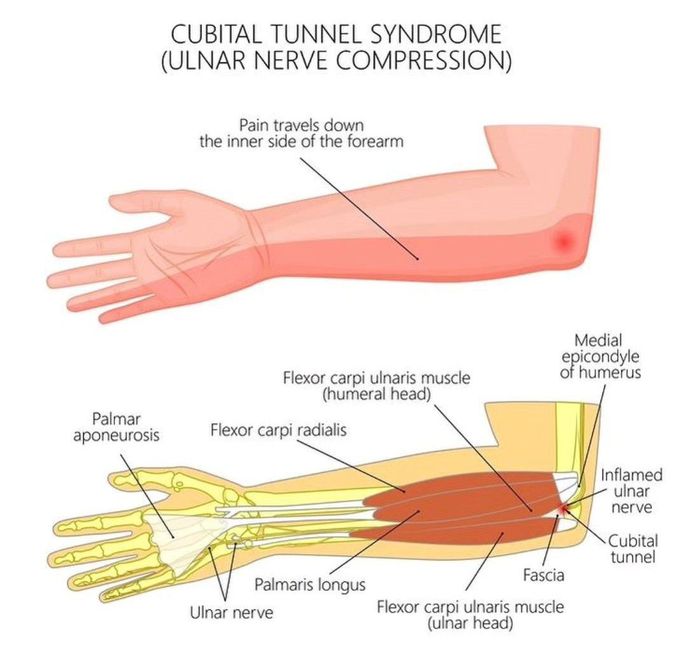 Carpal Tunnel Syndrome