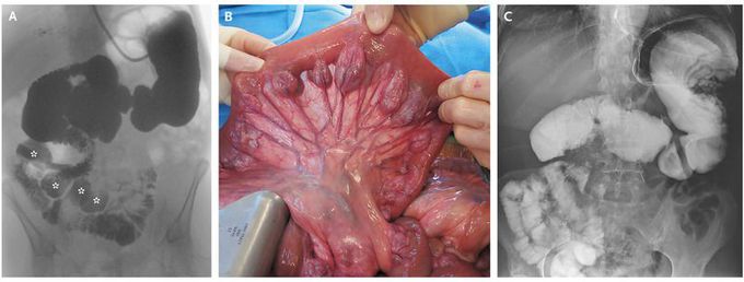 Jejunal Diverticulosis with Midgut Volvulus and Intestinal Malrotation