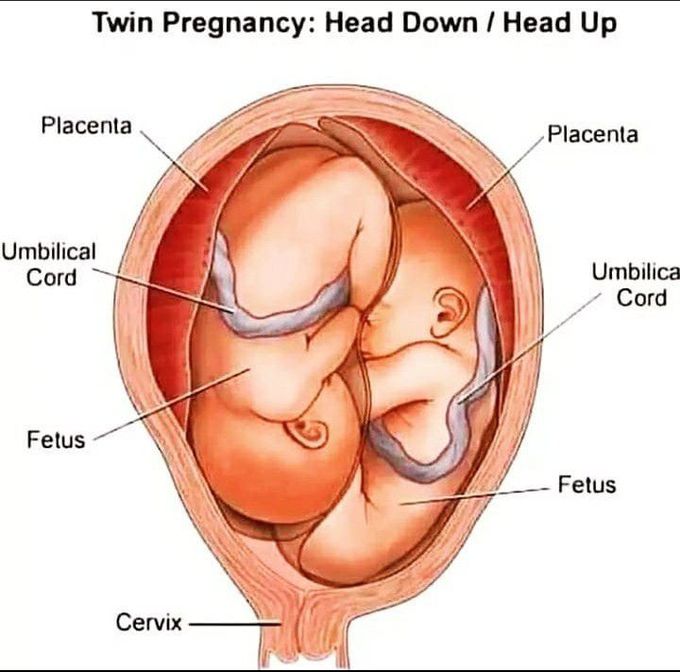 Twin pregnancy : Head down/ Head up
