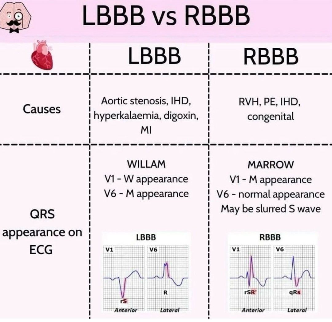 LBBB Vs RBBB - MEDizzy