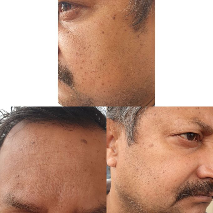 Diagnosis for lesions in face!