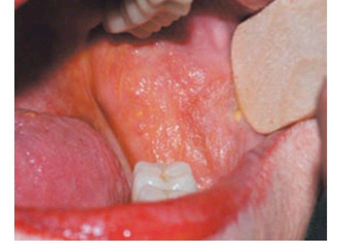 Symptoms of Sjögrens syndrome