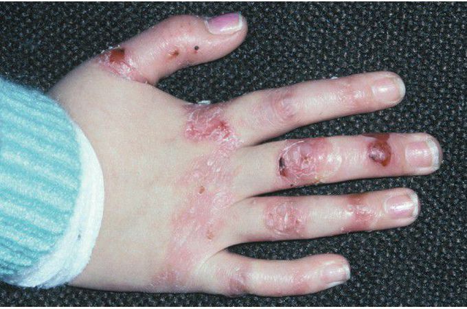 Epidermolysis Bullosa.