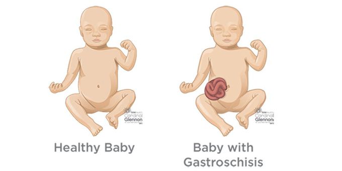 Gastroschisis