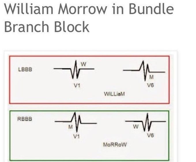 LBBB Vs RBBB