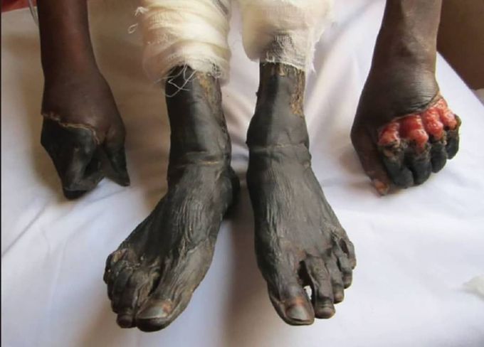 Gangrene