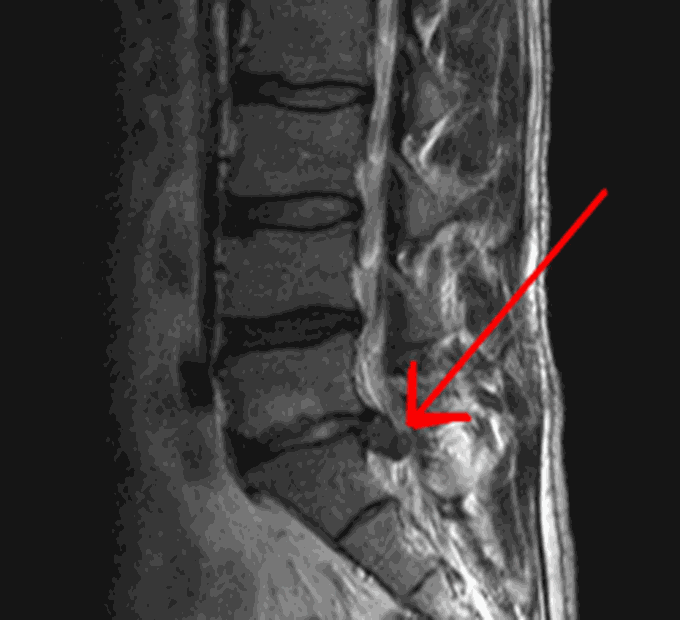 Investigation of Choice for Spinal Disc Herniation