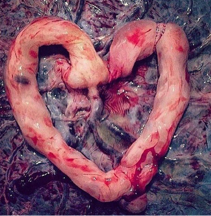 Umbilical cord