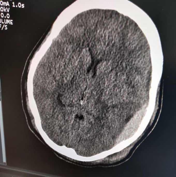 Epidural Hematoma