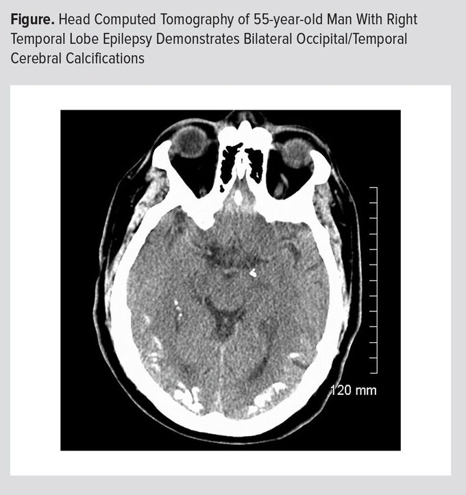 Cerebral calcification