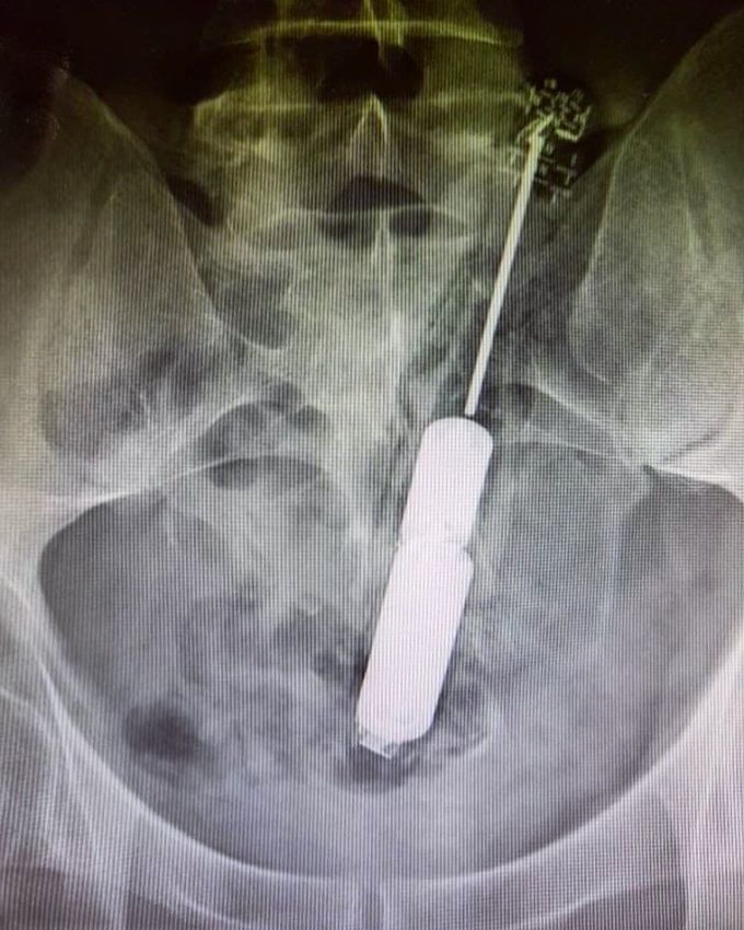 The patient presented to the ER after attempts at self-removal failed all at once.  