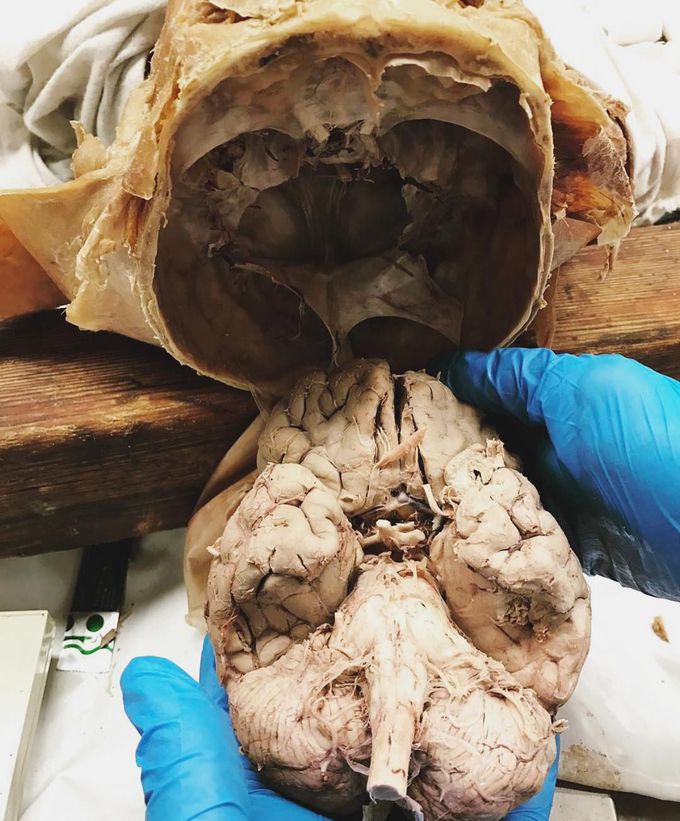 Human central nervous system beautifully dissected