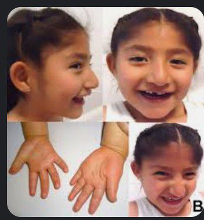 Angelman Syndrome.