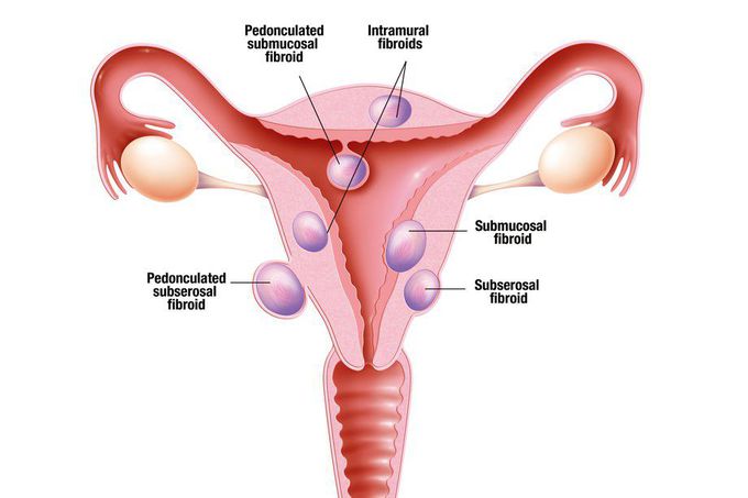 Types of Fibroids AKA Leiomyoma