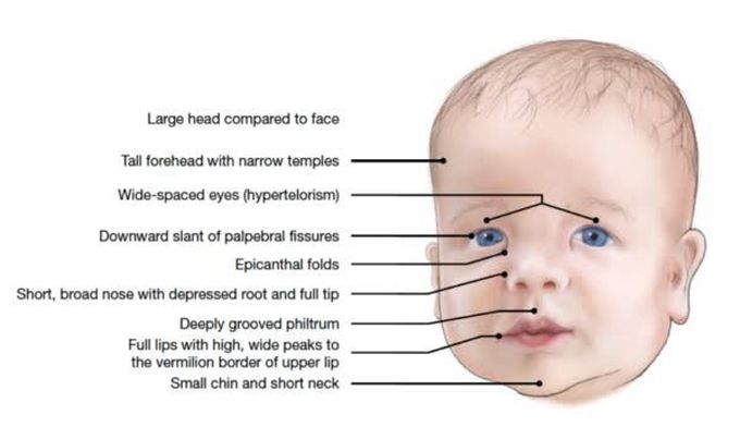 Symptoms and facial features of noonan syndrome