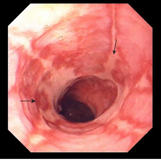 Complications of Gastro-esophageal Reflux DIsease