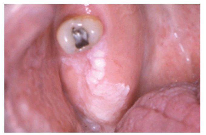 Frictional keratosis