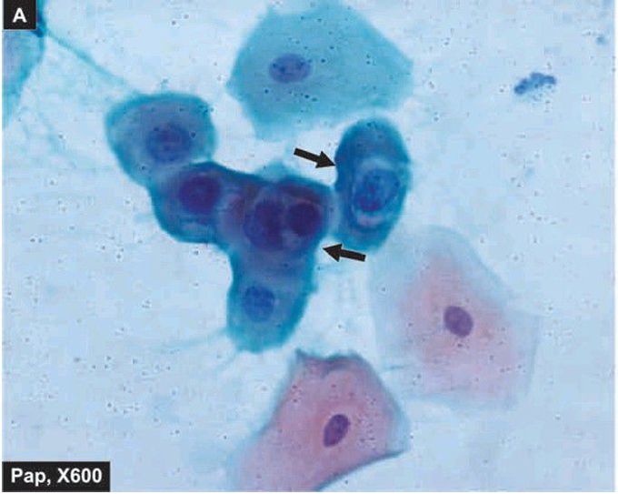 Low grade Squamous intraepithelial lesions