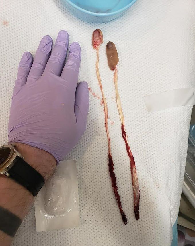 Patient’s fingers and connected tendons pulled out by a drilling incident.