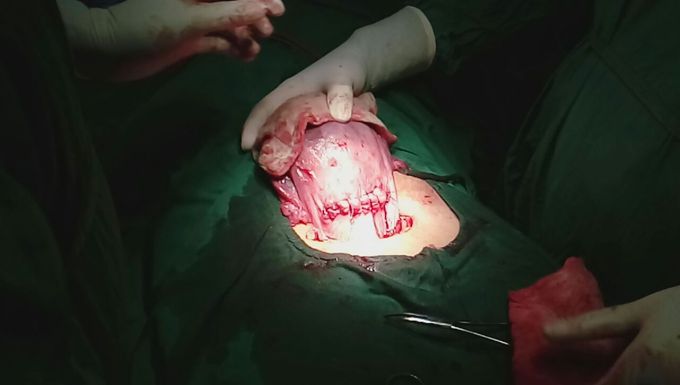 Uterus in LSCS OPERATION