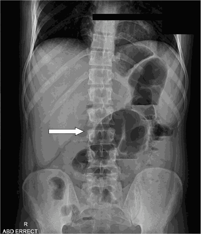 "Coffee Bean" sign on abdominal x-ray in a patient with Sigmoid Volvulus