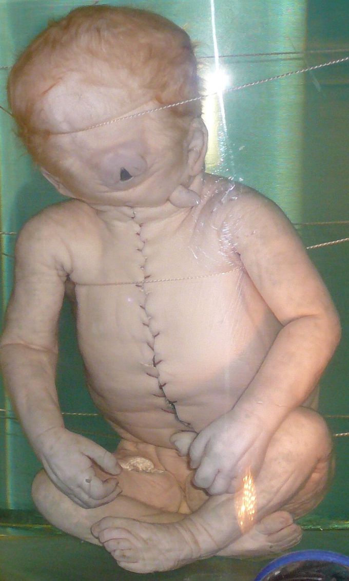 Cyclopia (One Eyed)
