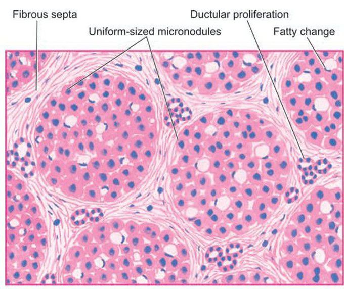 Alcoholic cirrhosis, microscopic appearance