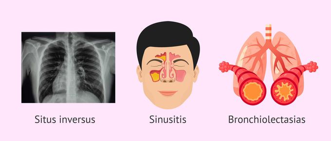 Kartagener's syndrome