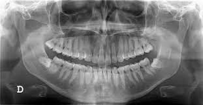 Relevant Findings For An Endodontist On Radiograph