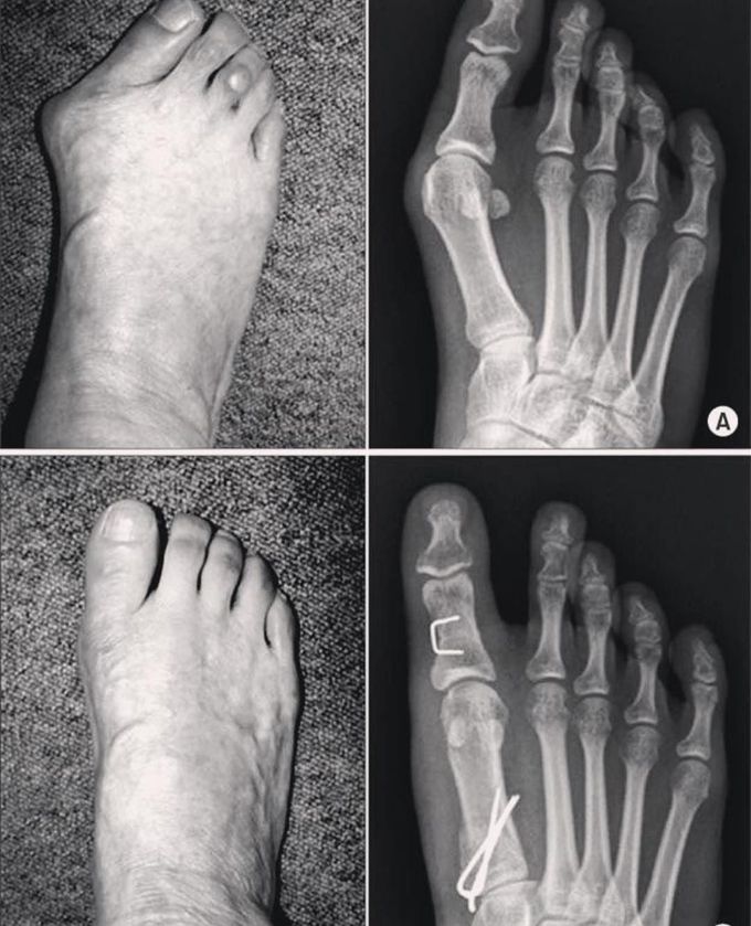 Hallux valgus