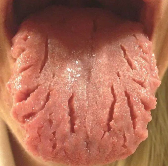 Fissured Tongue