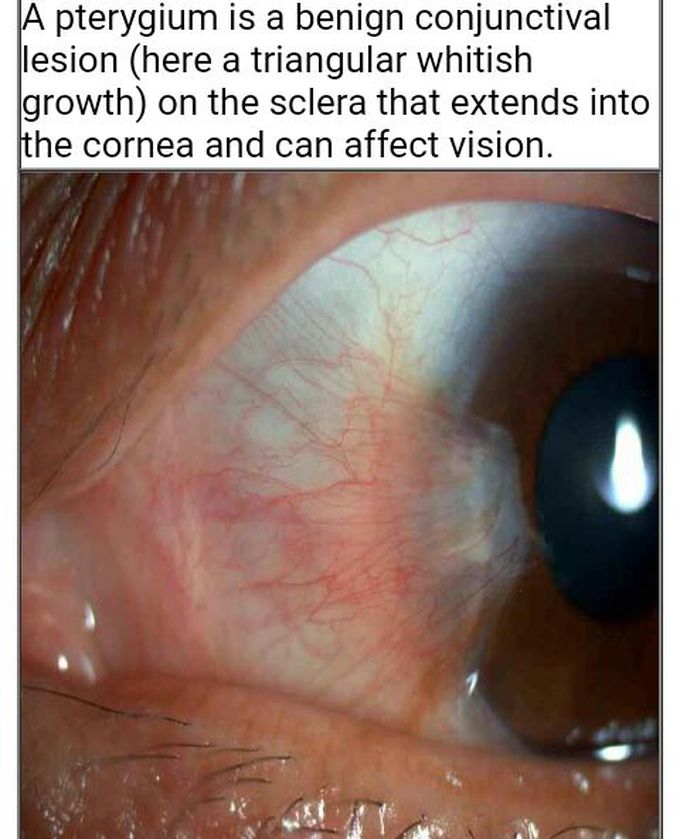 pterygium