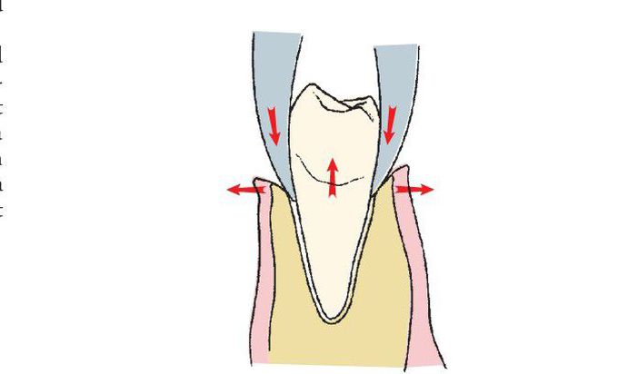 Principle of routine exodontia