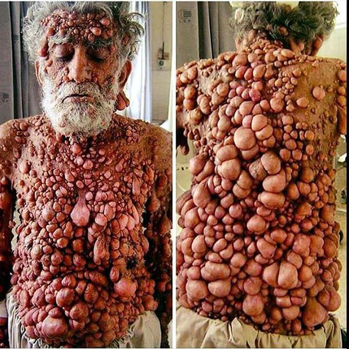 Neurofibromatosis