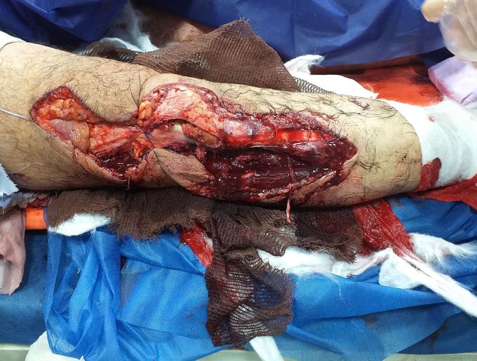 Motor accident