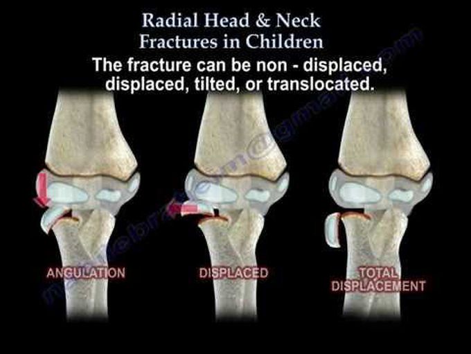 Neck Pain Causes and Treatment Everything You Need To Know Dr Nabil  Ebraheim 